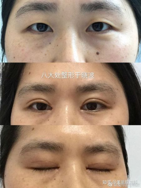 北京八大处于晓波双眼皮修复技术怎么样？