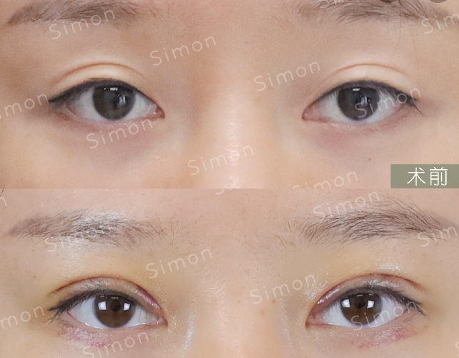 2022年杭州哪个医生做双眼皮修复比较好？