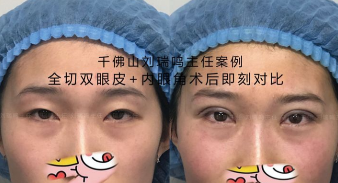 评美帮双眼皮专家刘瑞鸣割的双眼皮怎么样？