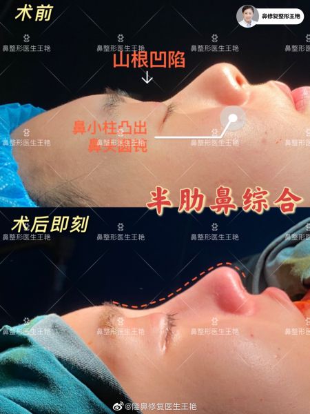 上海隆鼻专家王艳做鼻子技术怎么样？