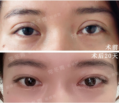 2022年北京高难度双眼皮修复哪个医生更厉害？
