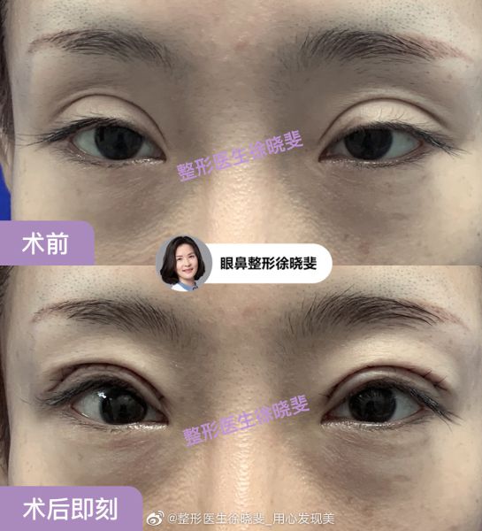 上海双眼皮修复专家徐晓斐修复眼睛怎么样？
