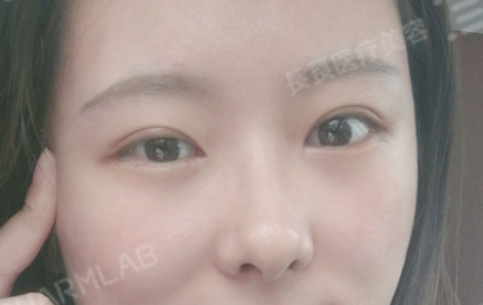 重庆眼修复专家刘晓伟双眼皮修复怎么样？