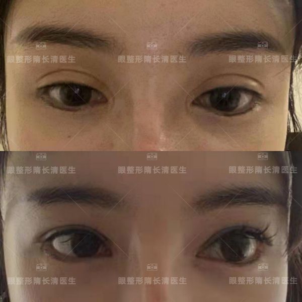 上海眼修复专家隋长清修复双眼皮怎么样？