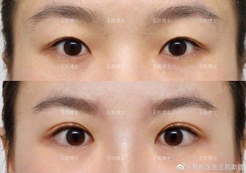 2022年郑州哪个医生修复双眼皮最好？