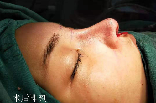 广州廖轶平医生做鼻子技术口碑怎么样？