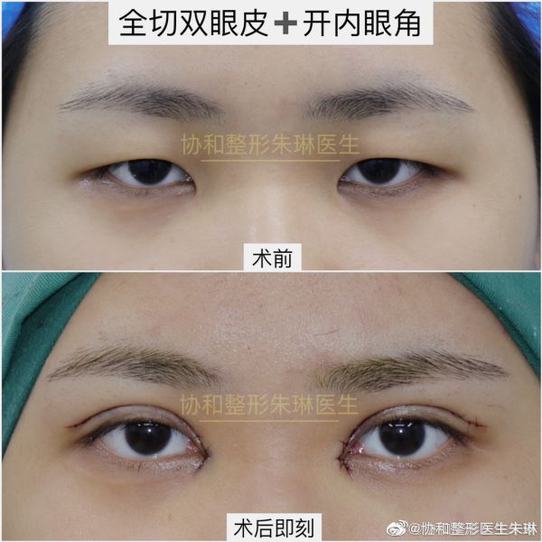 北京协和知名双眼皮专家朱琳割双眼皮怎么样？