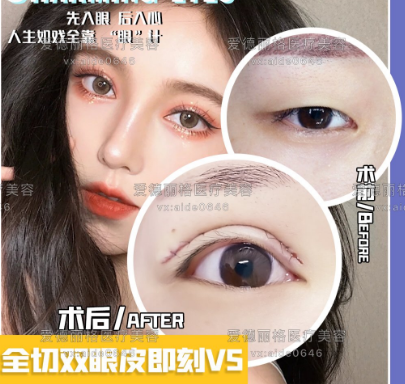 任召磊和刘志刚谁双眼皮&眼修复做的好？