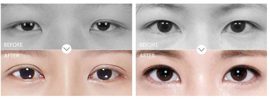 上海双眼皮专家杜园园修复外眼角怎么样？