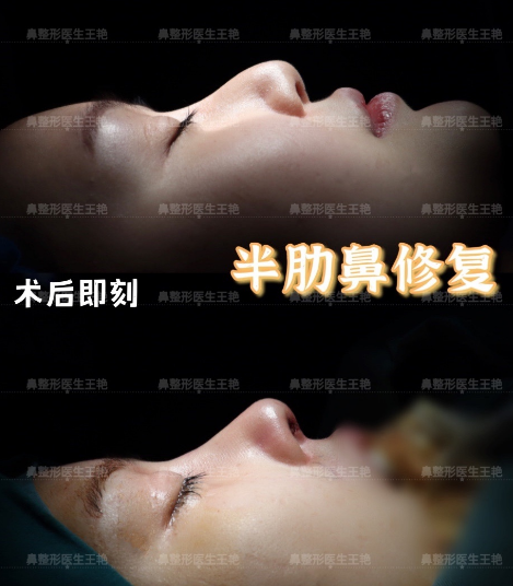 上海隆鼻专家王艳和沈国雄哪个鼻修复技术好？