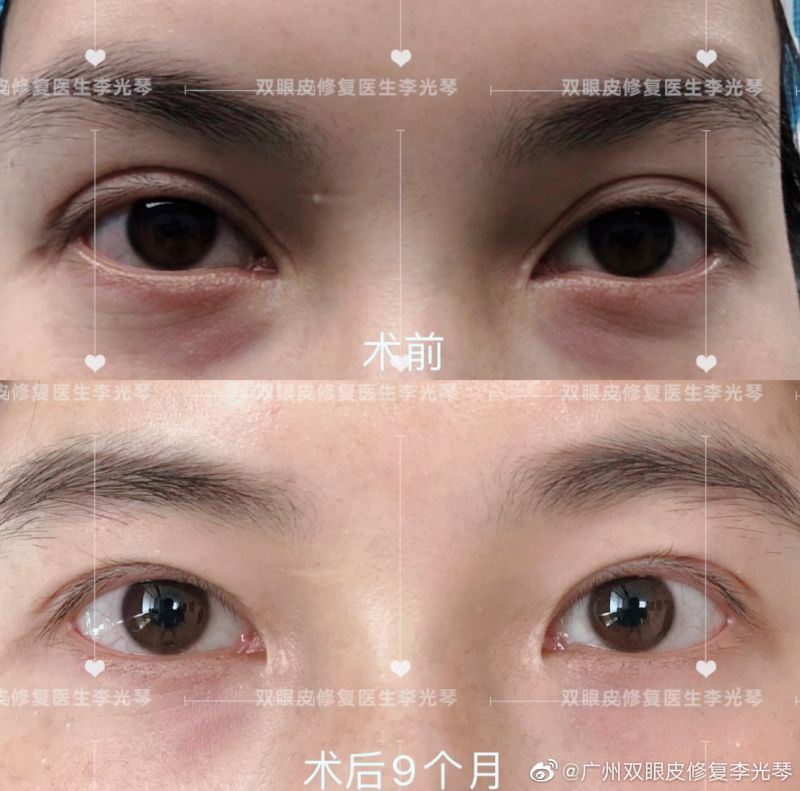 2022年广州双眼皮修复专家排名哪个最好？