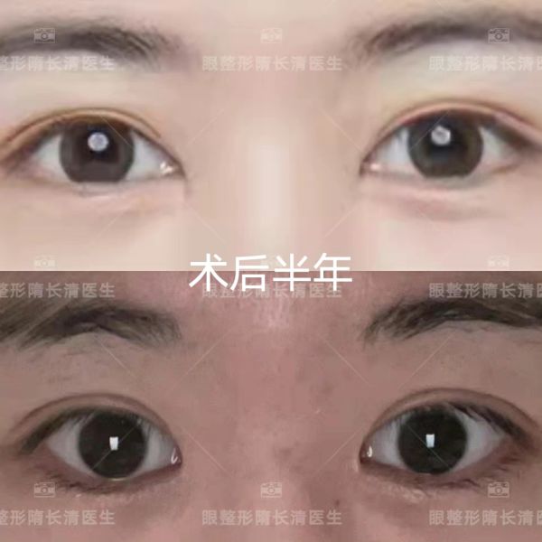 上海眼修复专家隋长青修复双眼皮怎么样？
