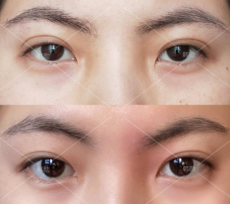 眼修复专家李燕和韩勋哪个做眼修复技术好？