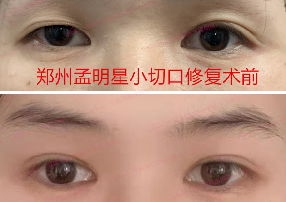郑州孟明星做双眼皮修复口碑怎么样？