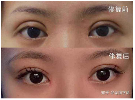 郑州眼修复专家贾亮双眼皮修复技术怎么样？