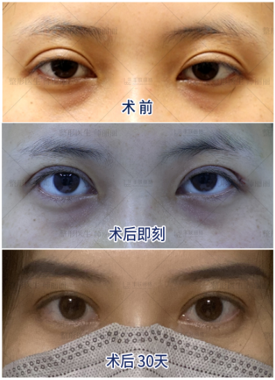 2022年北京修复双眼皮的女医生厉害的有哪些？