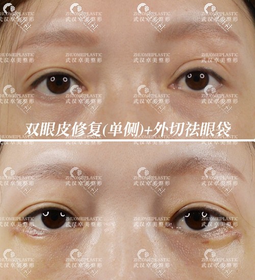 2022年武汉同济医院修复双眼皮最好的医生是谁？