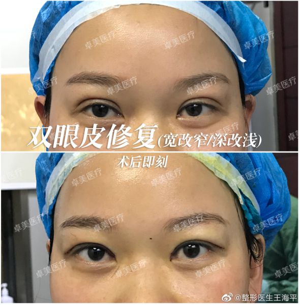 2022年武汉修复双眼皮哪个医生好？