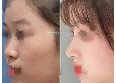 上海九院李圣利做鼻子口碑技术怎么样？