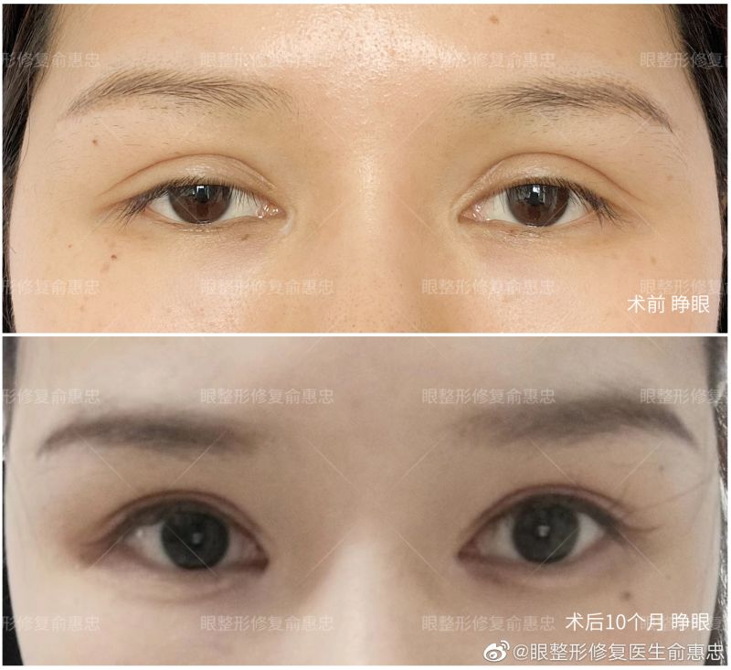 长沙修复双眼皮专家俞惠忠怎么样？