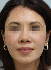 面部除皱方式瘦脸针水光针肉毒素谁更好？
