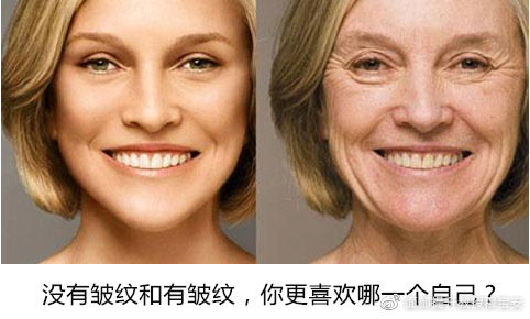 脸部皱纹分为哪几类？面部皱纹可以面部提升改善吗？