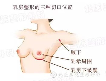 乳房假体有没有保质期？假体隆胸的切口会不会明显?