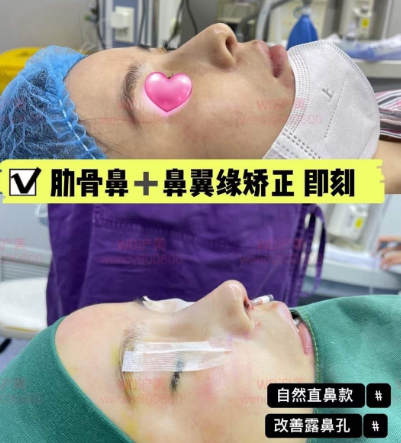 上海李章医生做的鼻子怎么样？