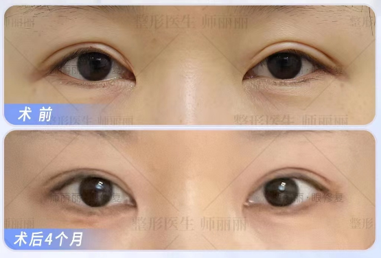 2023年北京双眼皮修复最好的专家排名榜单