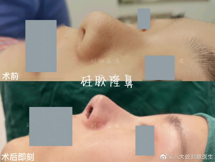 北京八大处隆鼻专家刘暾做的鼻子怎么样？