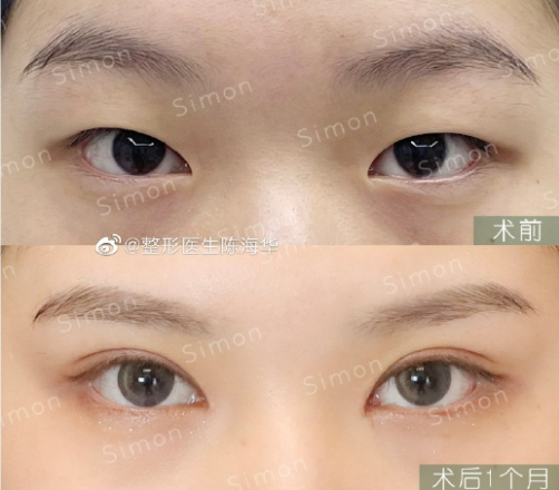 杭州眼整形医生陈海华做双眼皮技术怎么样？