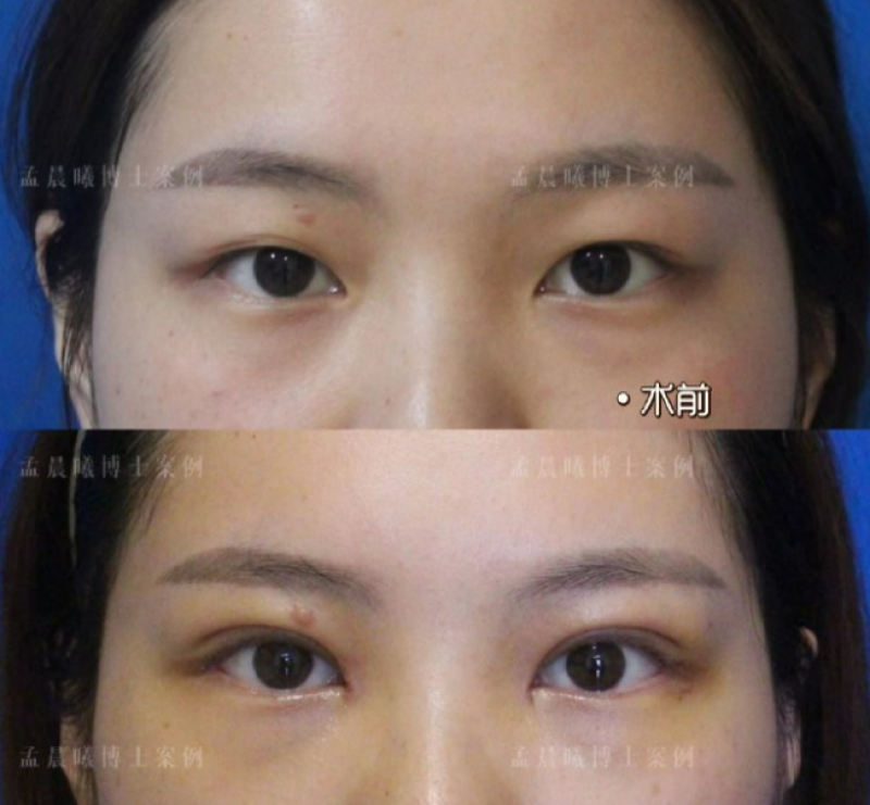 杭州双眼皮专家孟晨曦做双眼皮怎么样？