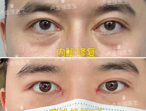 广州双眼皮医生卢金强做双眼皮修复怎么样？