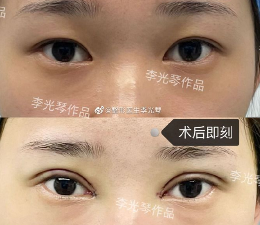 广州2023年双眼皮修复最好的医生是谁？