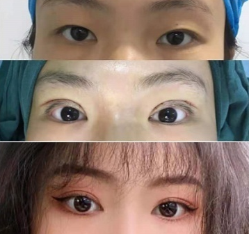 西京双眼皮医生宋宝强做双眼皮修复怎么样？