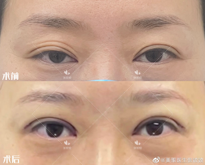 张姣姣双眼皮修复案例
