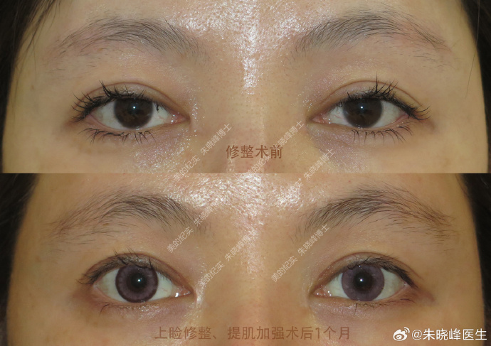北京双眼皮修复哪个医生好？朱晓峰、王维、韩勋、师丽丽、魏志香