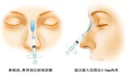 李文峰做鼻综合技术怎么样？手术费用贵不贵？