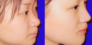 长沙隆鼻专家排行榜 长沙隆鼻最好的专家排名 长沙隆鼻最好的专家有哪些？