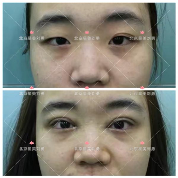 北京星美医疗美容双眼皮修复专家刘勇怎么样？
