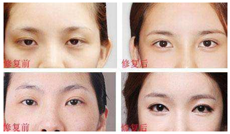 中国最好的双眼皮修复开眼角修复专家王世勇案例
