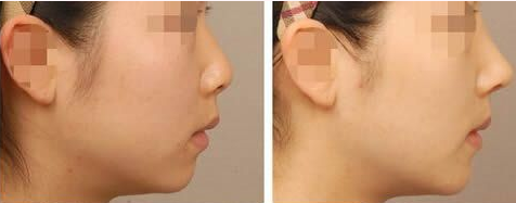 中国最厉害的鼻子整容（达拉斯隆鼻）专家：牛永敢（简介、案例、预约）