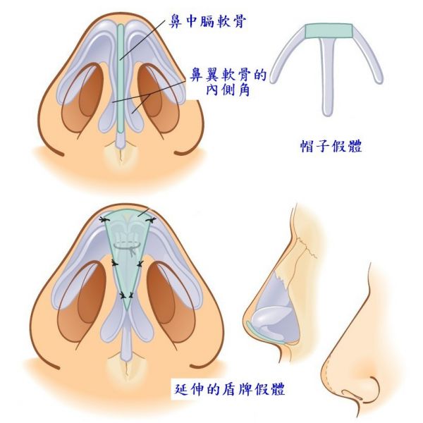 鼻整形奥秘（七）：什么是韩式隆鼻? 韩式隆鼻（韩式生科）有多少段式?