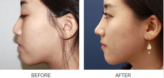 北京八大处整形做鼻子鼻综合鼻修复最好的专家价格表大全