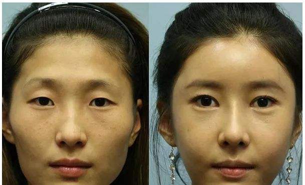 中国最好的眼整形&双眼皮修复专家：曹仁昌（案例、预约）在哪个医院？