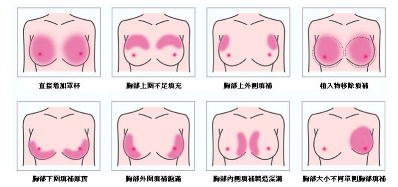 果冻矽胶隆乳和自体脂肪隆胸的区别是什么？自体脂肪隆胸案例精选