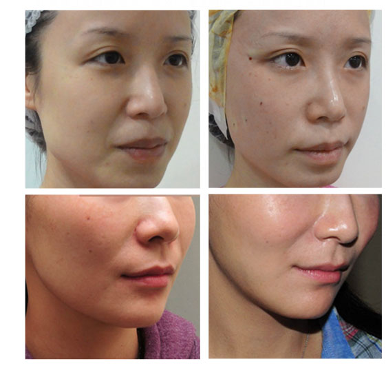 面部老化现象皮肤粗糙缺少光泽 老化现象脸部松垮缺紧致感怎么办？