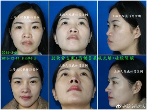 上海九院最好的隆鼻修复专家：戴传昌（简介、案例、预约）