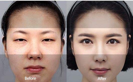 杭州出名的双眼皮和双眼皮修复医生哪个最好？杭州双眼皮修复专家排名