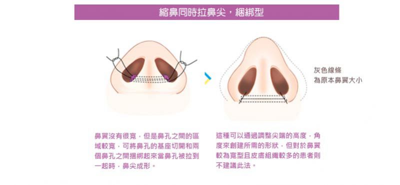 鼻翼缩小是什么意思 减少鼻孔外扩蒜头扁鼻